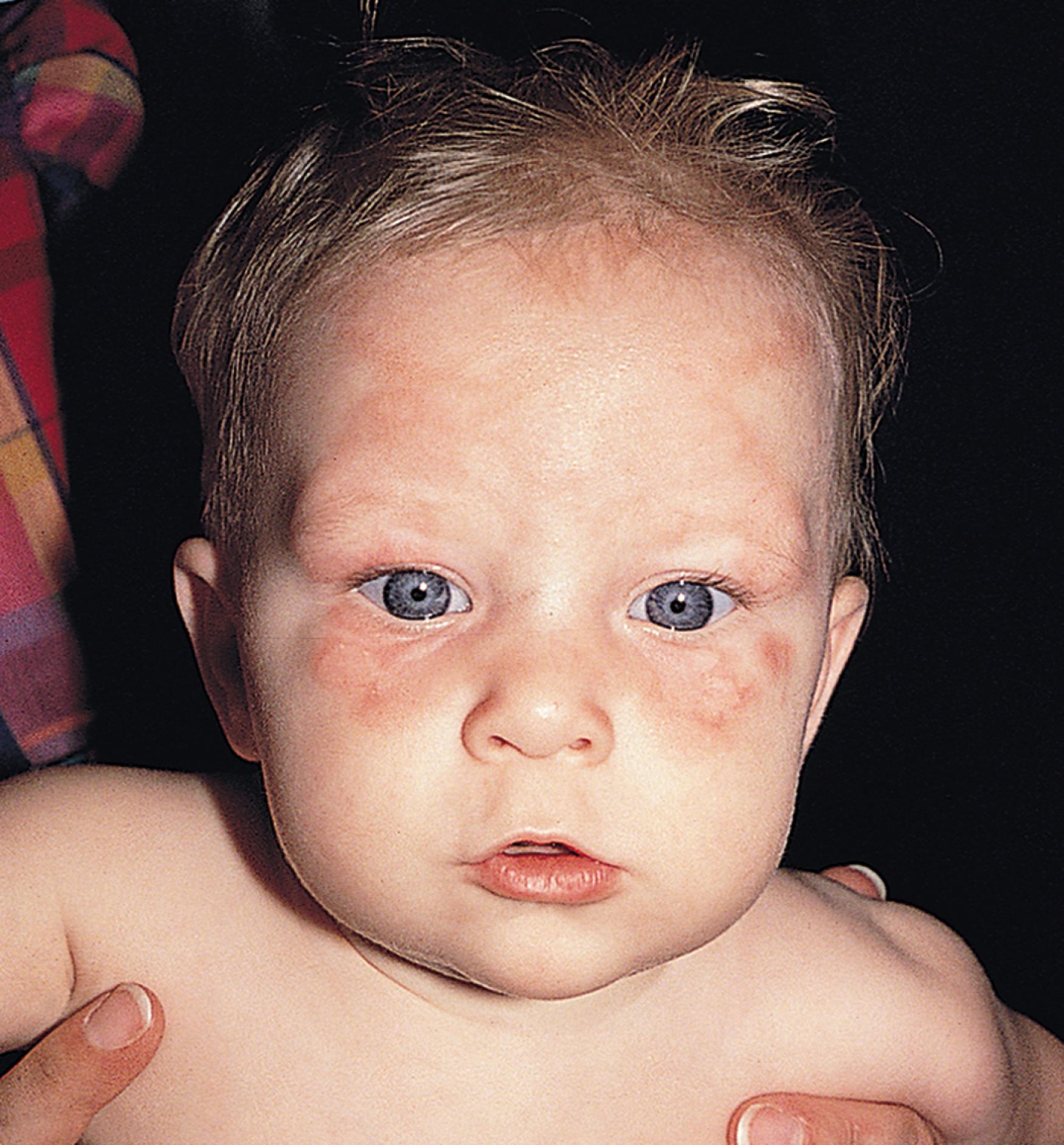 Fig. 60.6, “Raccoon eyes” eruption of neonatal lupus erythematosus.