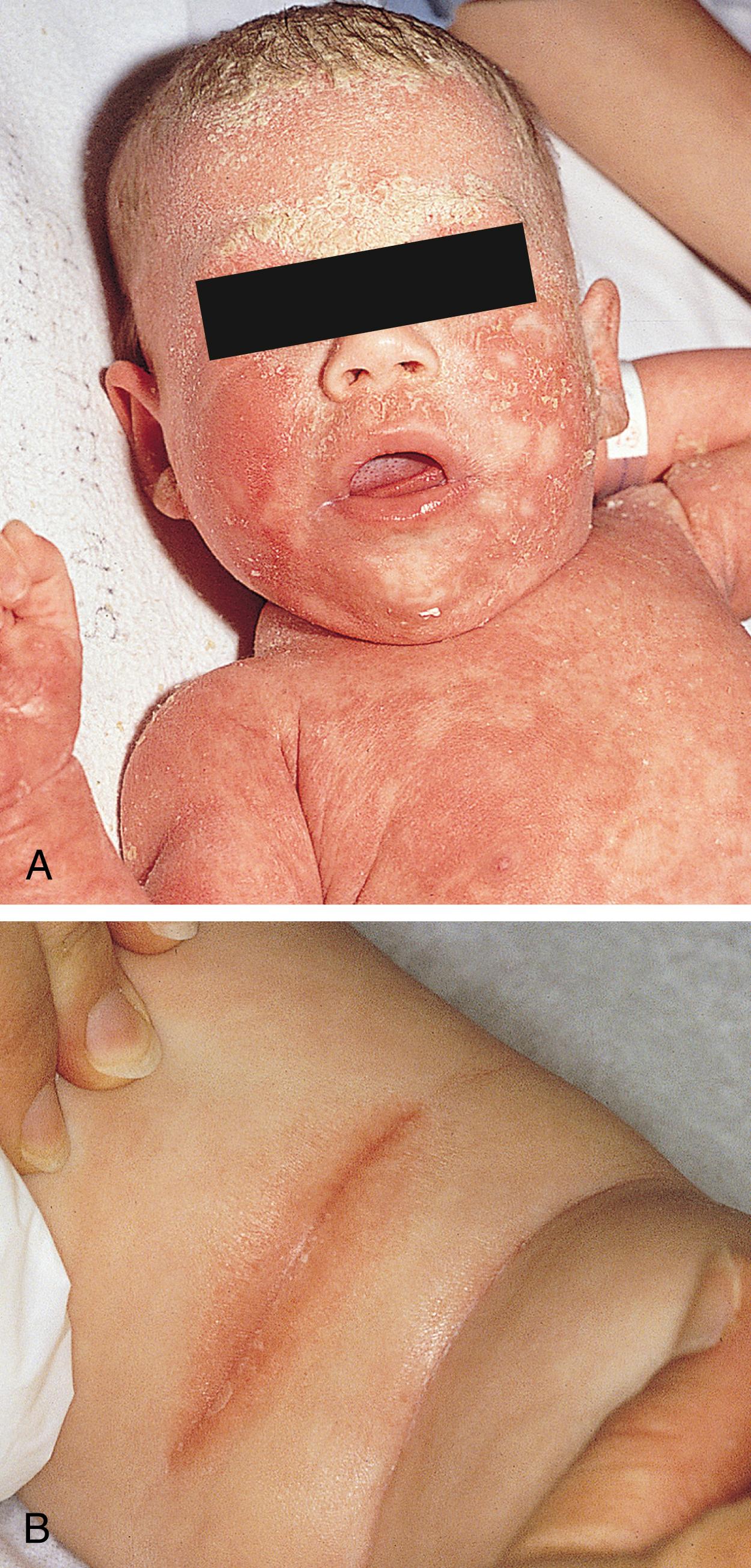 Fig. 60.7, A, Seborrheic dermatitis may occasionally be widespread. B, The body folds are often involved in seborrheic dermatitis.