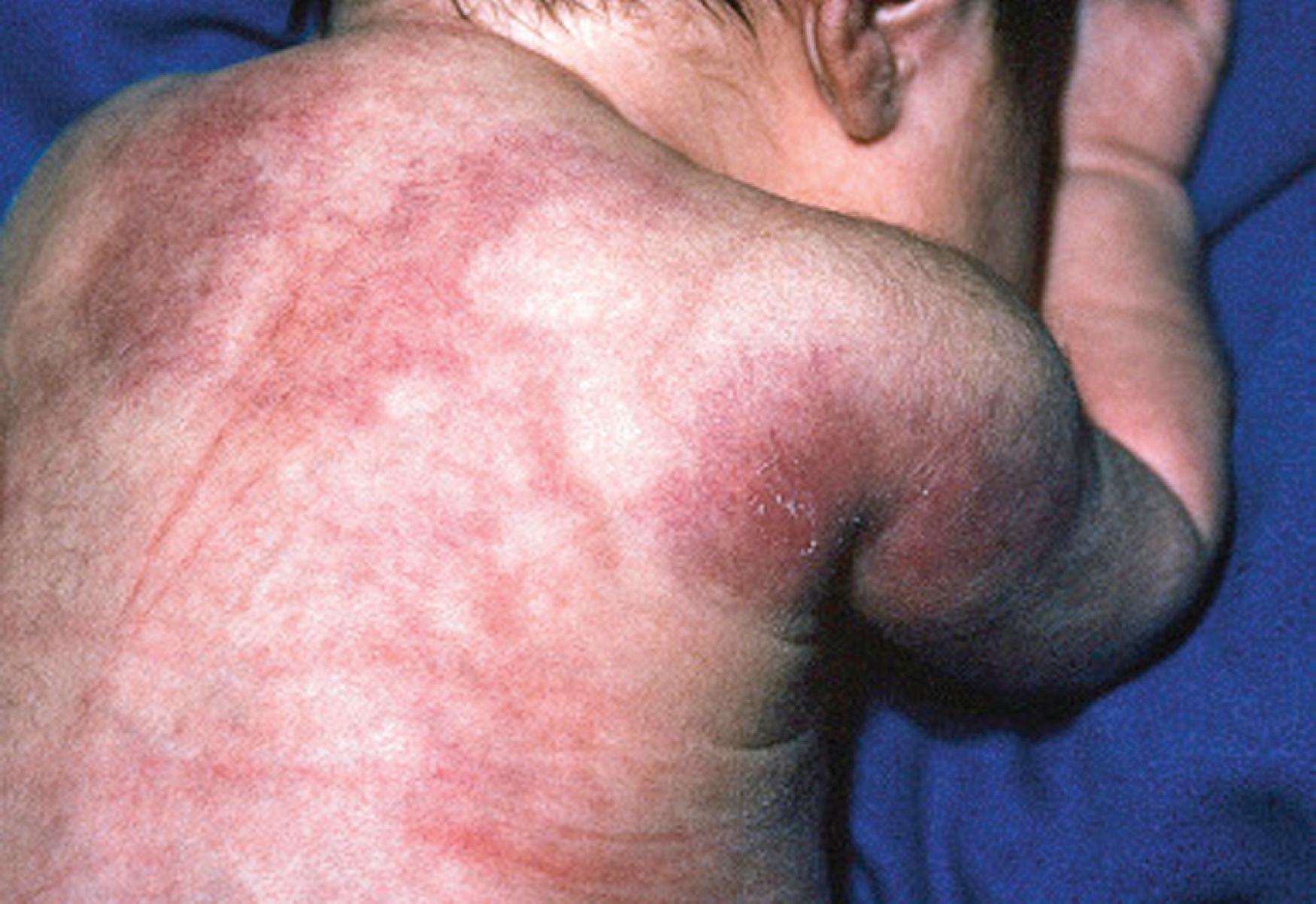 Fig. 60.8, Subcutaneous fat necrosis. Indurated, erythematous plaques on the shoulders and back of this 1-week-old boy.