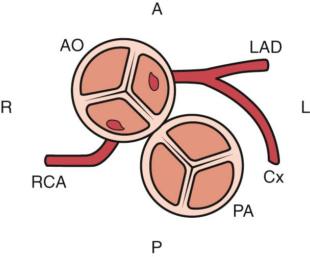 Fig. 75.1, Most common coronary artery arrangement in D-transposition of the great arteries. The aortic root is anterior and rightward of the pulmonic root in D-TGA. The right coronary artery arises from the rightward posterior-facing sinus, whereas the left coronary artery arises from the leftward anterior-facing sinus. A, Anterior; Ao, aorta; Cx, left circumflex coronary artery; L, left; LAD, left anterior descending coronary artery; P, posterior; PA, pulmonary artery; R, right; RCA, right coronary artery.