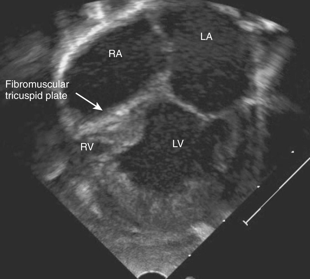 Fig. 75.3, Apical four-chamber view on echocardiogram of a neonate with tricuspid atresia. There is no tricuspid valve with a fibromuscular plate in its usual place. A large atrial septal defect permits flow from the right atrium ( RA ) to the left atrium ( LA ) and into the left ventricle ( LV ). The right ventricle ( RV ) is severely hypoplastic.