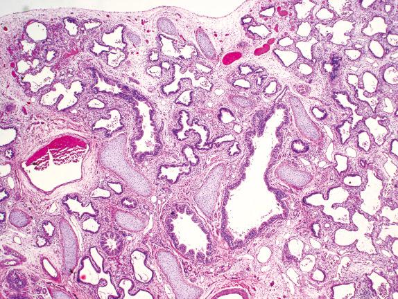 FIG. 4.2, Acinar dysgenesis. Microscopically, the lobules contain dilated branching airways and large airspaces resembling growth arrest after the pseudoglandular phase of development. No saccular structures or alveoli are present.