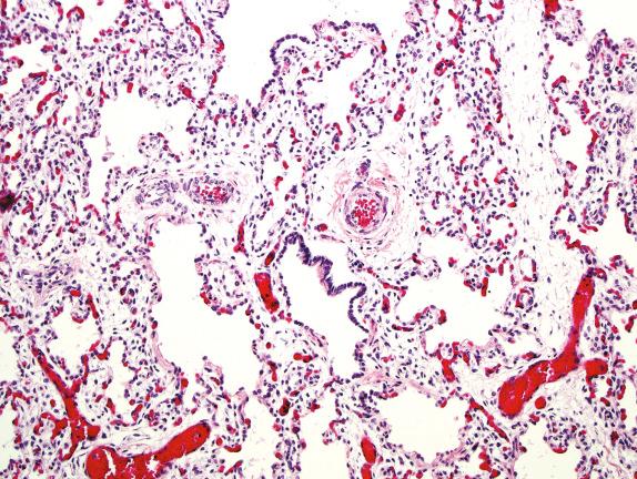 FIG. 4.3, Congenital alveolar dysplasia. The lung development appears arrested at a later stage in development than acinar dysgenesis, in this case resembling early saccular development in a term neonate.