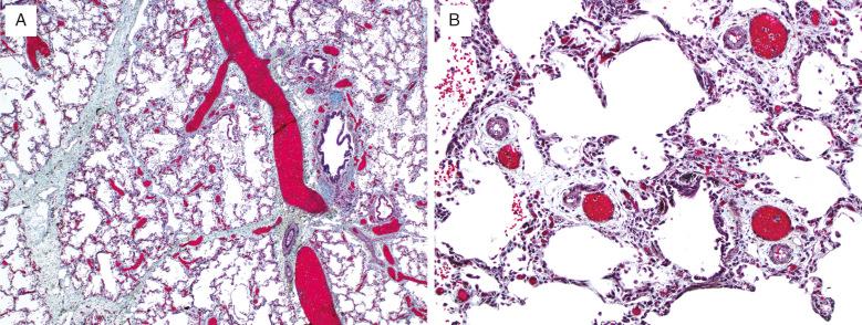 FIG. 4.4, Alveolar capillary dysplasia with misalignment of pulmonary veins. Abnormal veins are markedly congested and malpositioned, accompanying the pulmonary artery branches and airways (A). Within the lobules, the dilated venules accompany the lobular arterioles and the alveolar capillary bed is deficient (B) (Movat pentachrome stain).