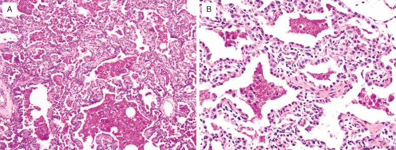 FIG. 4.5, Pulmonary alveolar proteinosis pattern (surfactant protein B, ABCA3 mutations). Mutations in the surfactant protein B gene (A) and ABCA3 gene (B) typically result in a pulmonary alveolar proteinosis pattern in infants, with slightly granular abundant eosinophilic proteinosis material in airspaces, occasional foamy histiocytes, and diffuse alveolar epithelial hyperplasia (periodic acid Schiff).