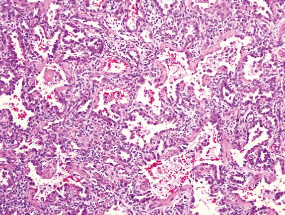 FIG. 4.6, Chronic pneumonitis of infancy pattern (surfactant protein C mutation). Mutations in surfactant protein C result in variable morphology depending in part on age at diagnosis. In infants, the lung typically has a pattern of chronic pneumonitis of infancy, characterized by lobular remodeling, diffuse prominent alveolar epithelial hyperplasia, scattered globular eosinophilic proteinosis material, and foamy histiocytes, often with occasional cholesterol cleft formation. Mutations or deletions in NKX2-1 gene encoding TTF1 may cause a similar pattern of disease.