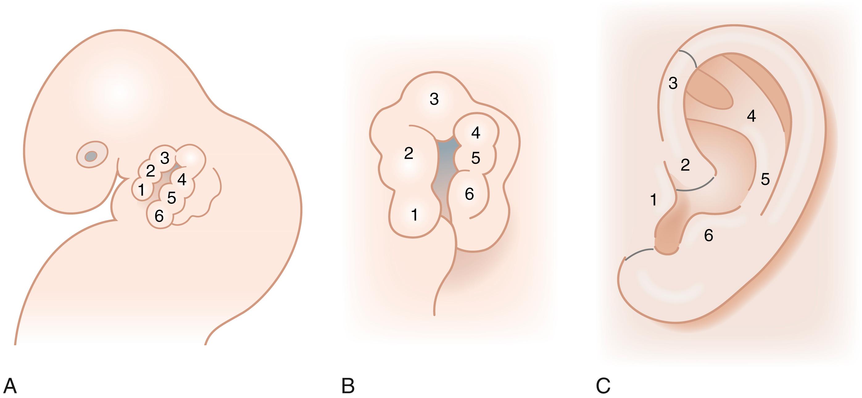 Fig. 18.1, Embryology of the external ear. Hillock formation in an 11-mm human embryo. Hillock configuration at 6 weeks’ gestation in a 15-mm embryo and hillock derivations in the adult auricle. 1, tragus, 2, root of helix, 3, helical rim, 4, superior and inferior crus, 5 antihelix, 6, anti-tragus