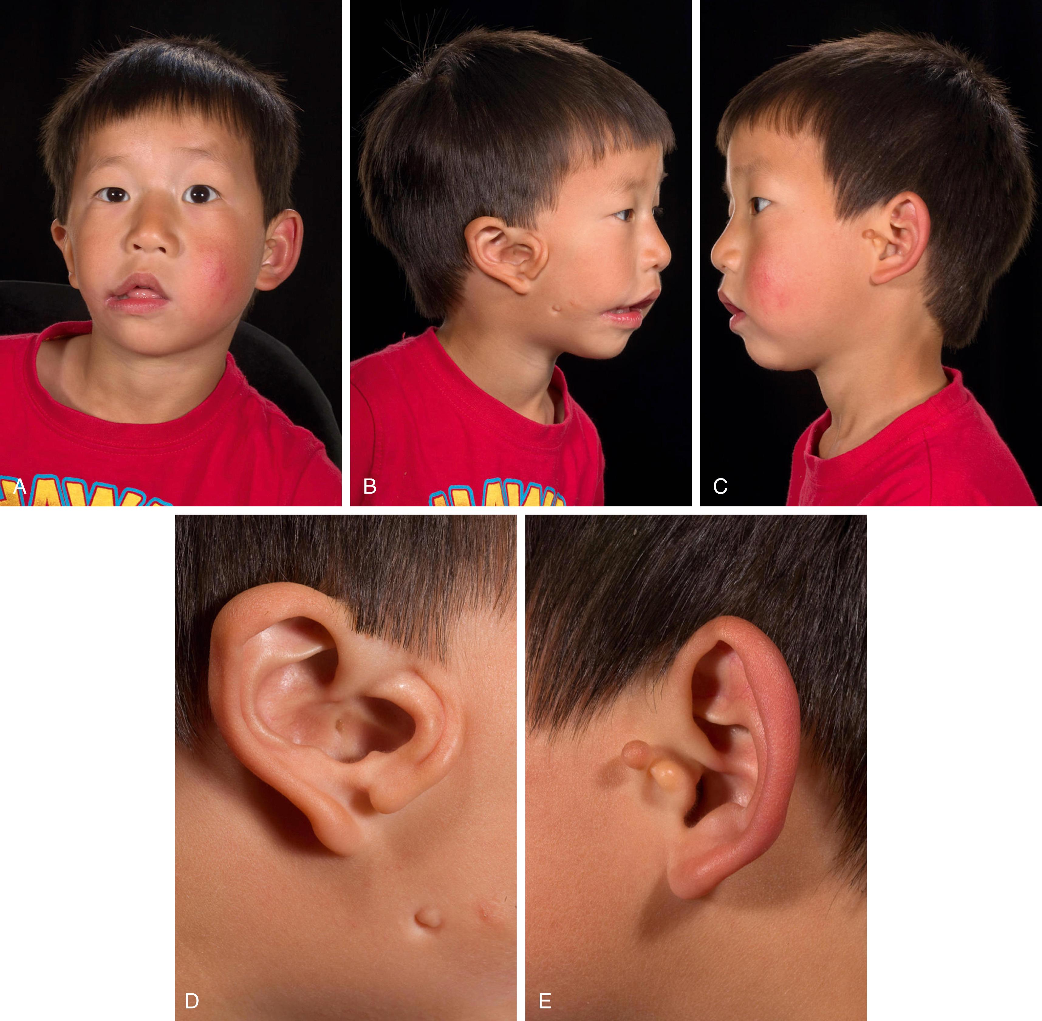 Fig. 18.2, (A–E) Patient with oculo-auriculo-vertebral spectrum who presented with simple preauricular skin tags on the left ear (E) and classic mirror ear on the right ear (D).