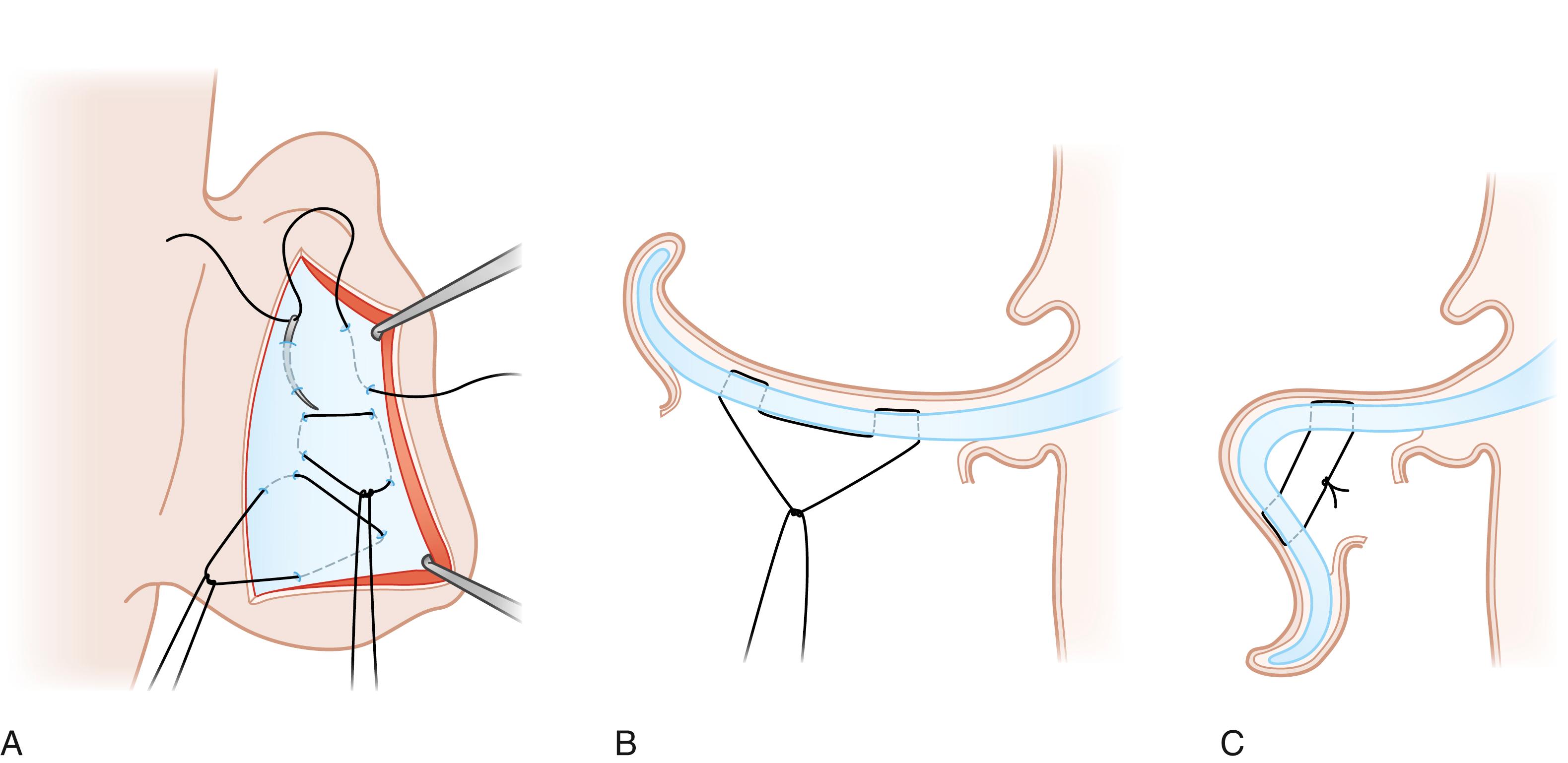 Fig. 18.4, (A–C) Diagrammatic illustration of Mustardé mattress suture placement for creation antihelical fold.