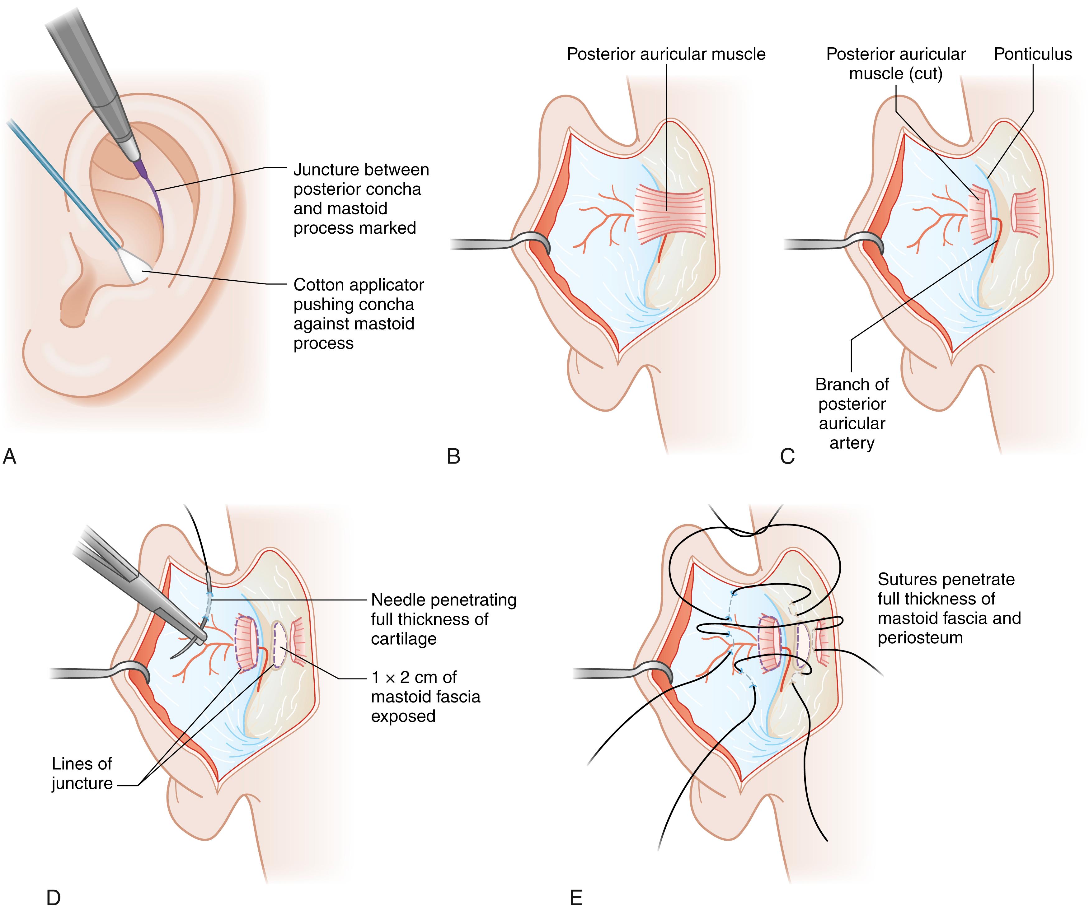 Fig. 18.5, (A–E) Diagrammatic illustration of key steps in the operative technique for placement of concha–mastoid sutures as originally described by Furnas.