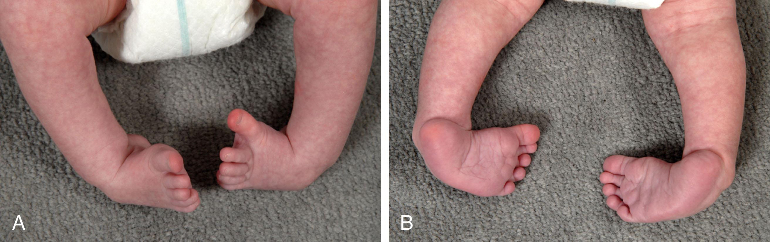 Fig. 41-1, Bilateral congenital clubfoot in a newborn. A , Adduction and supination of forefoot and equinus of hindfoot are apparent on anterior view. B , Inversion, plantar flexion, and internal rotation of calcaneus, as well as cavus deformity with transverse plantar crease, can be seen on the posterior view.