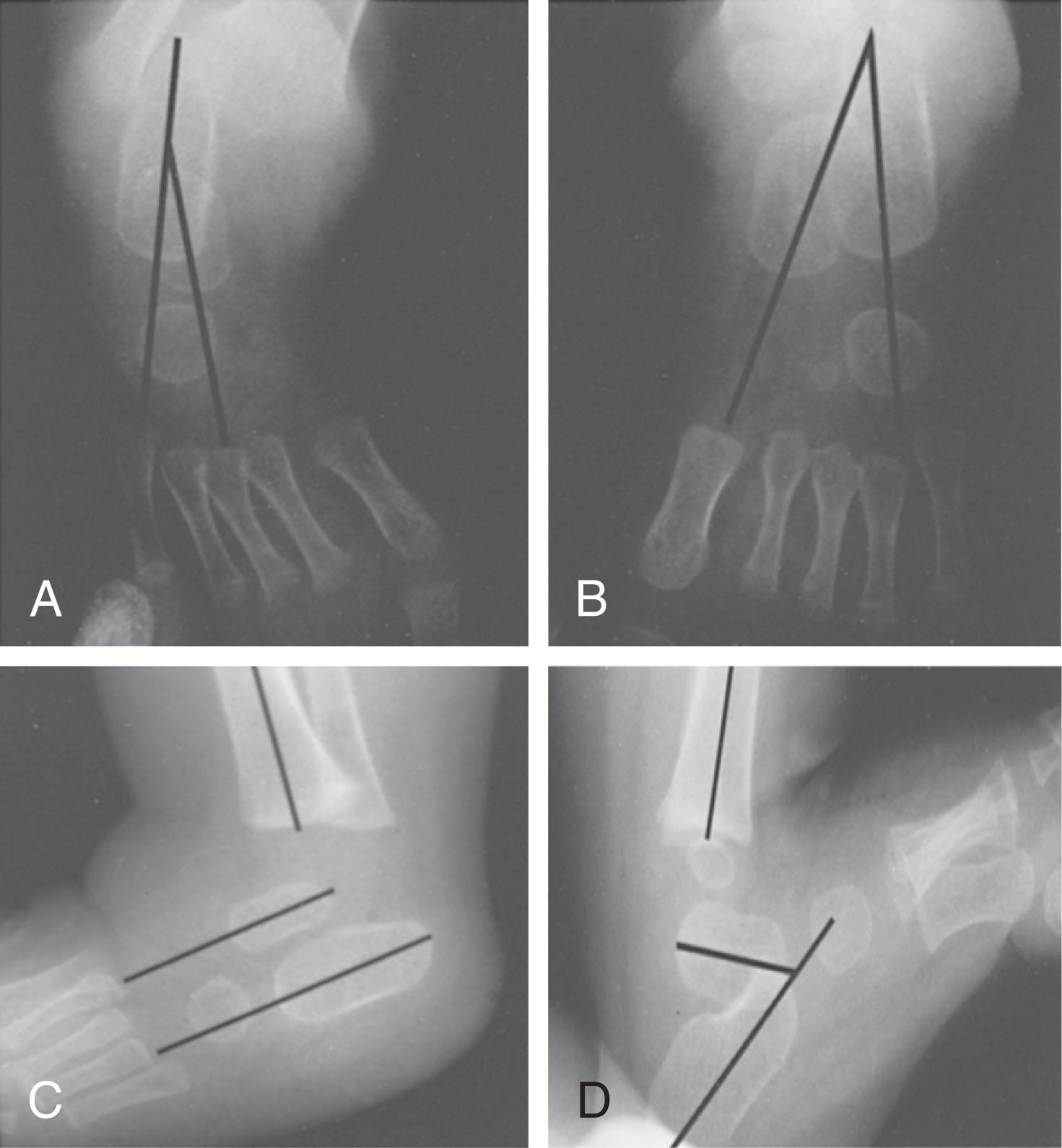 Fig. 41-2, Radiographic evaluation of clubfoot. A , Decreased talocalcaneal angle and negative talus–first metatarsal angle on anteroposterior view of right clubfoot. B , Talocalcaneal angle of normal left foot. C , Talocalcaneal angle of zero and negative tibiocalcaneal angle on dorsiflexion lateral view of right clubfoot. D , Same angles in normal left foot.