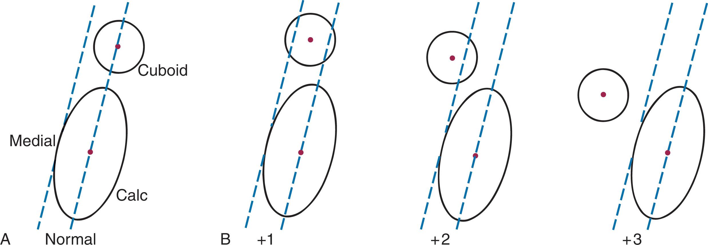 Fig. 41-3, Radiographic grading system forcalcaneocuboidmalalignment in flatfoot. A , When the midpoint of the cuboid ossification center lies on the longitudinal axis of calcaneus, no malalignment is present (grade 0). B , When the midpoint of the cuboid ossification lies between the calcaneal axis and a line along the medial border of the calcaneus parallel to the calcaneal axis (medial tangent), malalignment is grade 1. In grade 2 malalignment,the central point of the cuboid ossification center lies medial to the medial tangent. In grade 3 malalignment,the cuboid migrates proximally, with the central point of ossification center near or proximal to the distal calcaneal ossification center. Calc , Calcaneal ossification center; Cuboid , cuboid ossification center.