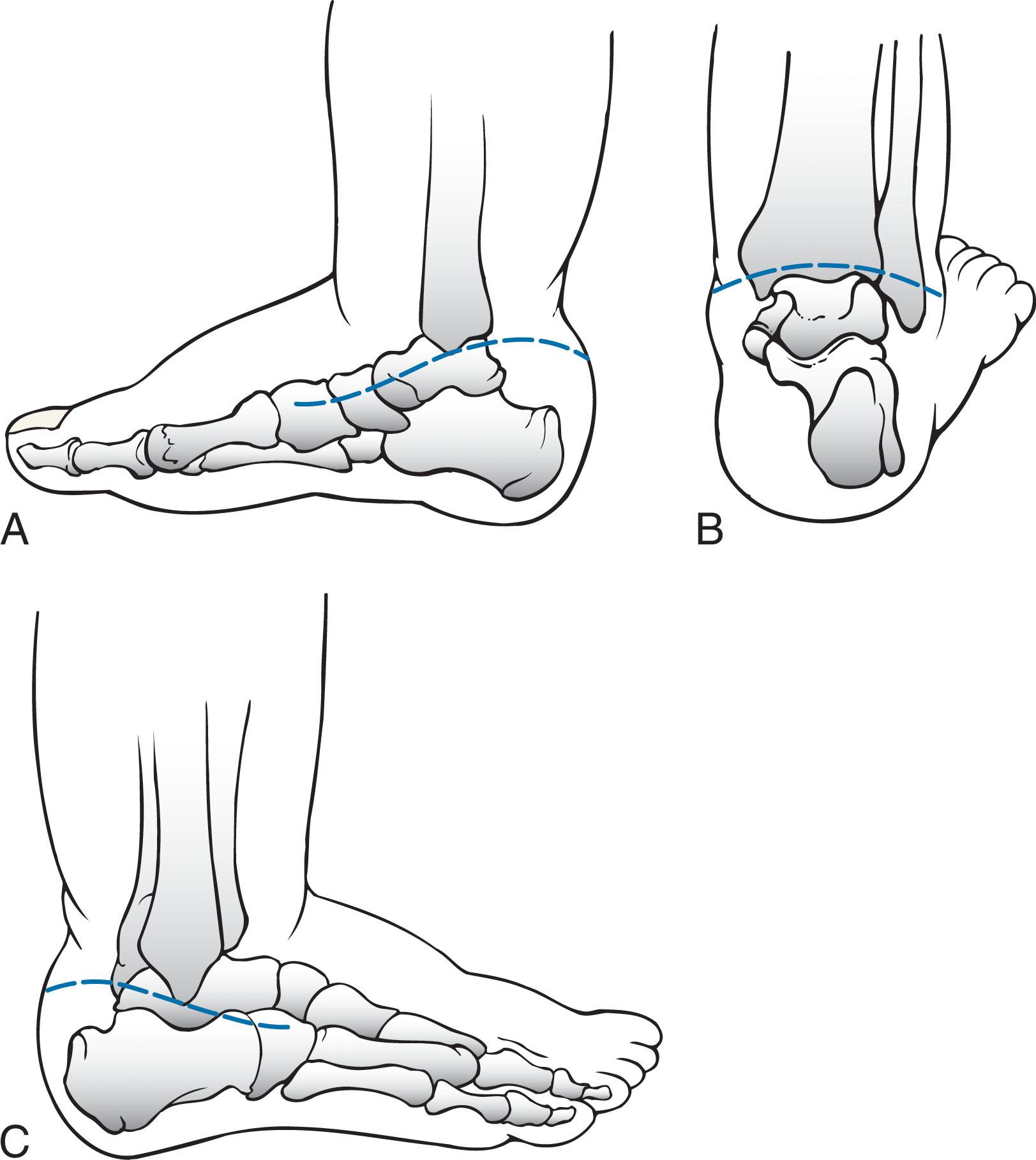 Fig. 41-4, Transverse circumferential (Cincinnati) incision. A , Medial view. B , Posterior view. C , Lateral view.