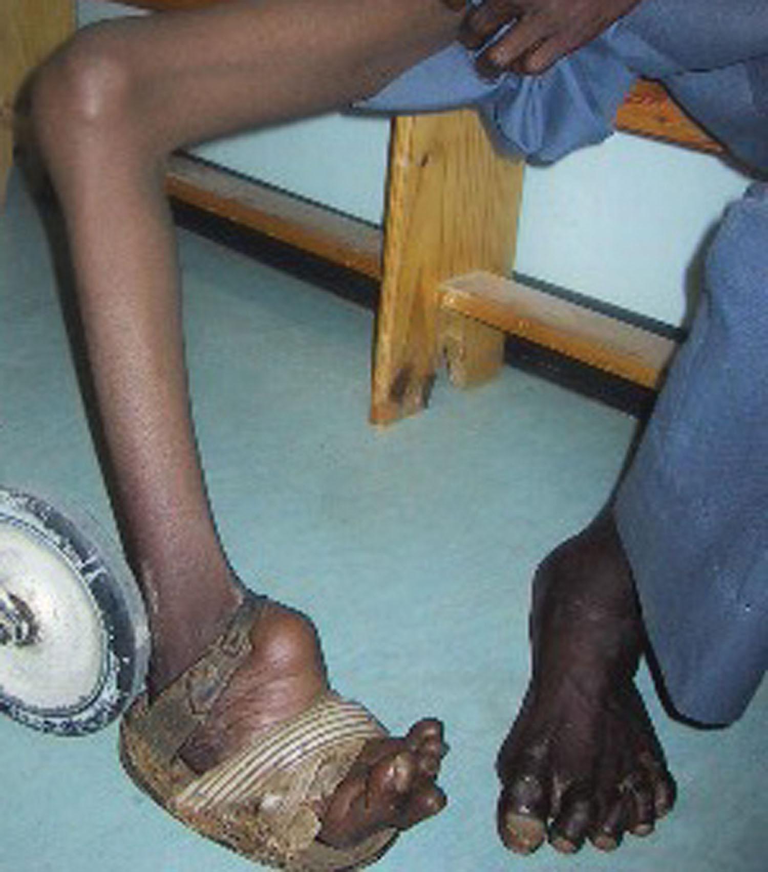 Fig. 41-5, Severe uncorrected clubfoot.