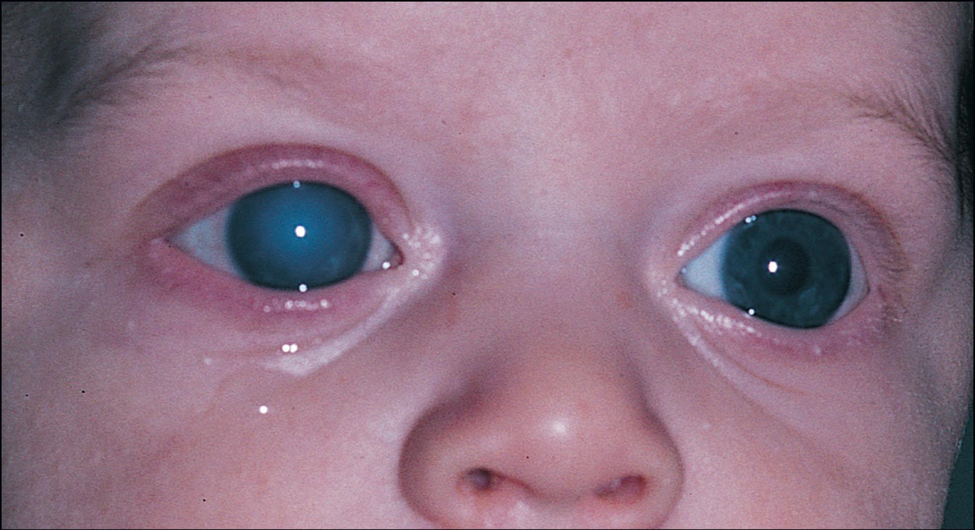 Fig. 10.20.1, Clinical Appearance of Primary Congenital Glaucoma.