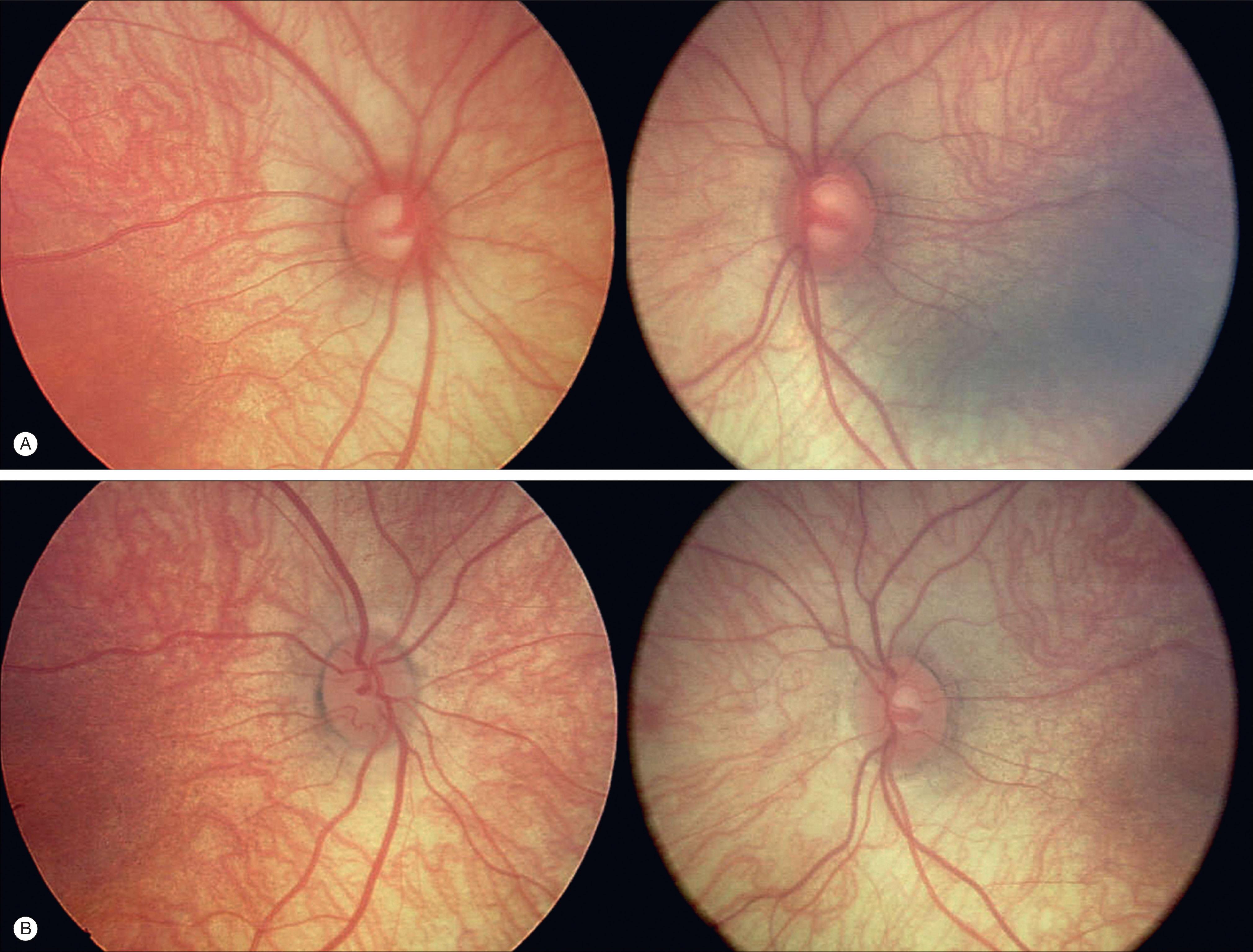 Fig. 10.20.3, Reversal of Optic Disc Cupping After Successful Treatment of Primary Congenital Glaucoma.