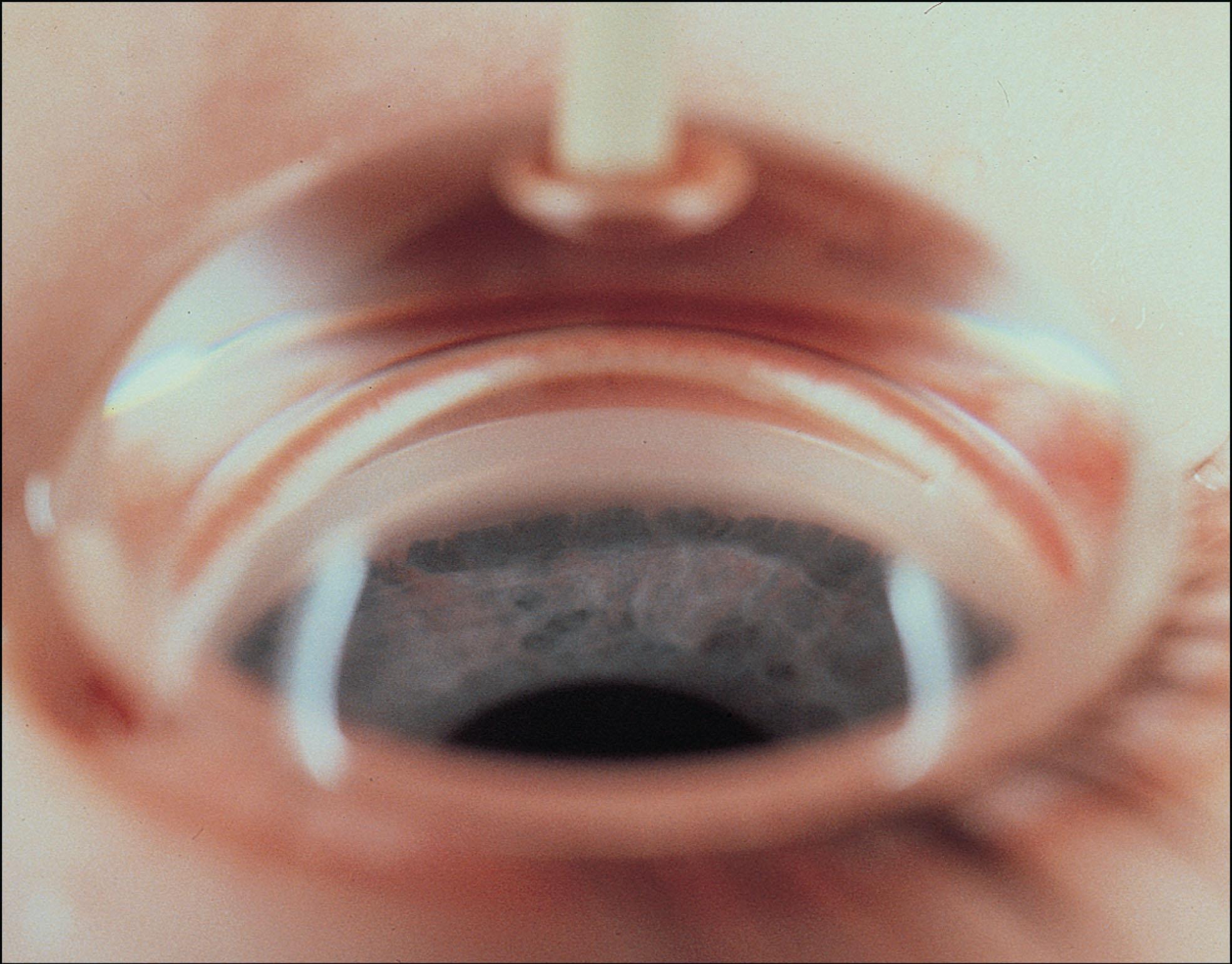 Fig. 10.20.4, Gonioscopic Appearance of the Anterior Chamber Angle in Primary Congenital Glaucoma.