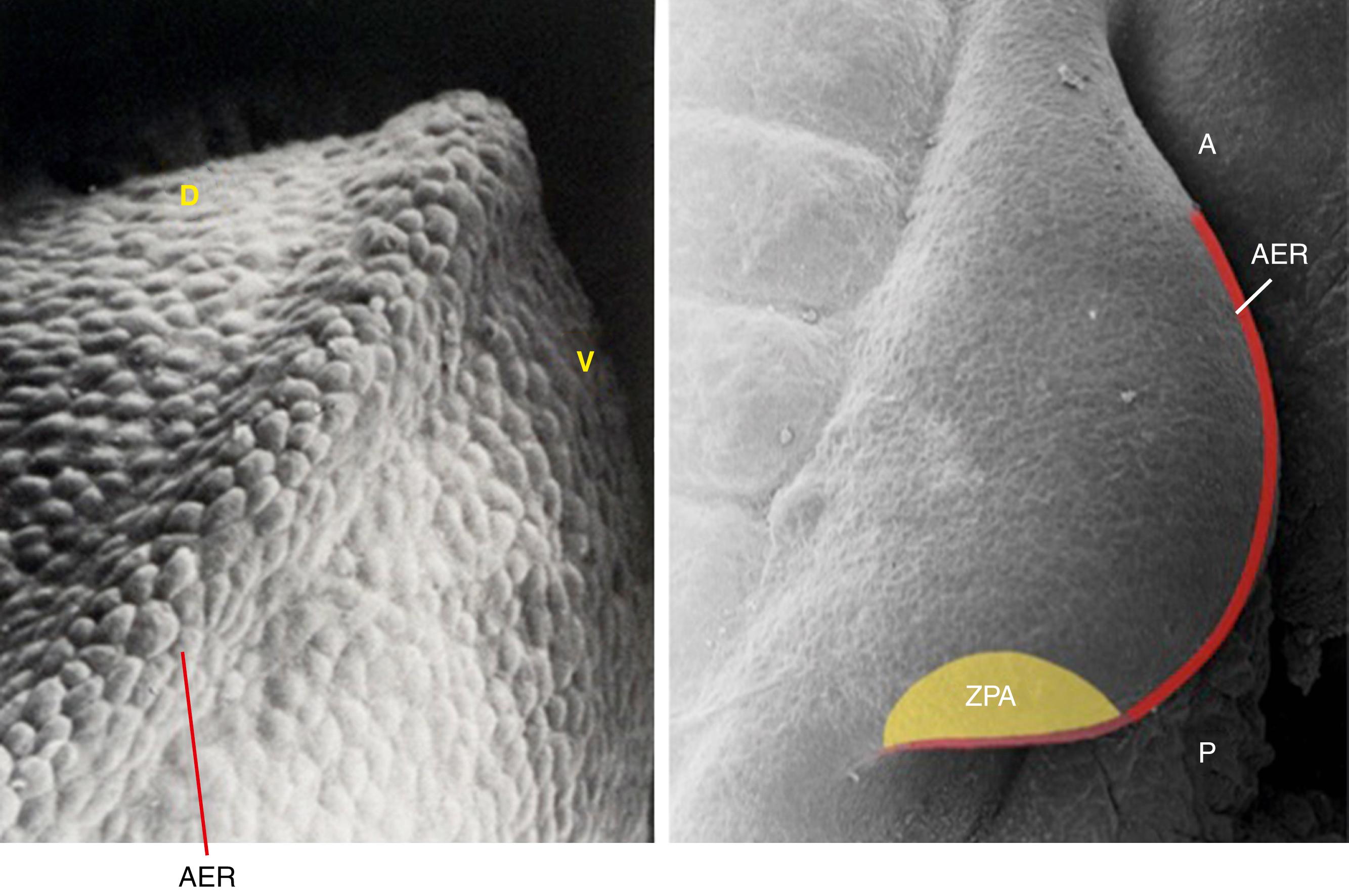 Fig. 45.1, Development and patterning centers of the upper limb. Limb patterning is coordinated along three axes that are intimately linked through feedback loops. Outgrowth of the limb from proximal to distal is driven by the apical ectodermal ridge ( AER ). The anteroposterior axis is controlled by the zone of polarizing activity ( ZPA ) through the morphogen sonic hedgehog (SHH). Dorsal ( D ) and ventral ( V ) patterning is controlled via engrailed‐1 (EN1), which is expressed in the ventral ectoderm and WNT7A, whose expression is limited to the dorsal ectoderm.