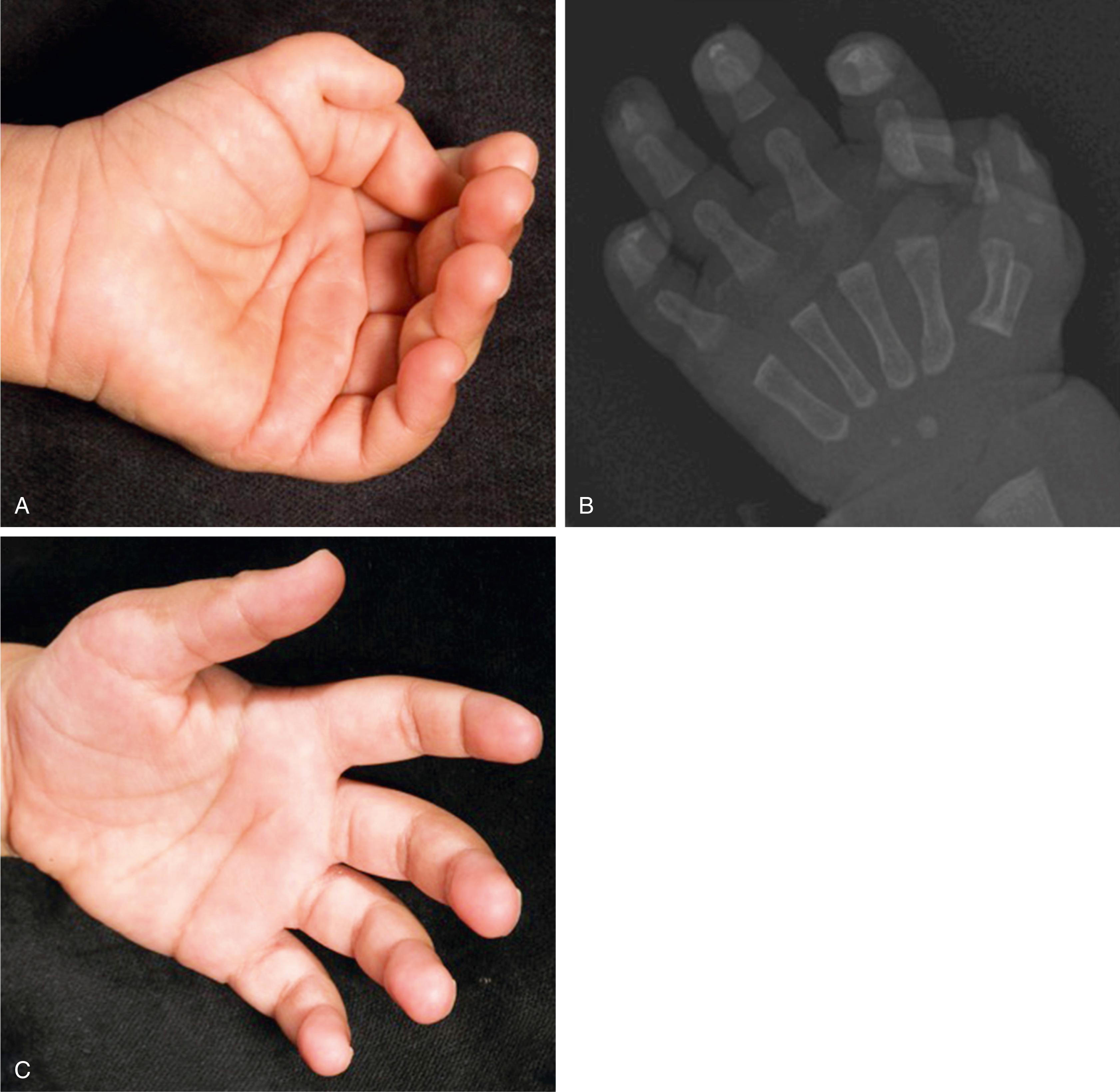 Fig. 45.11, Reconstruction of a Wassel type VII duplication. (A) Preoperative image of an unbalanced type VII duplication. (B) Preoperative radiograph demonstrating smaller triphalangeal radial duplicate. (C) Postoperative image of corrected type VII duplication after removal of radial duplicate.