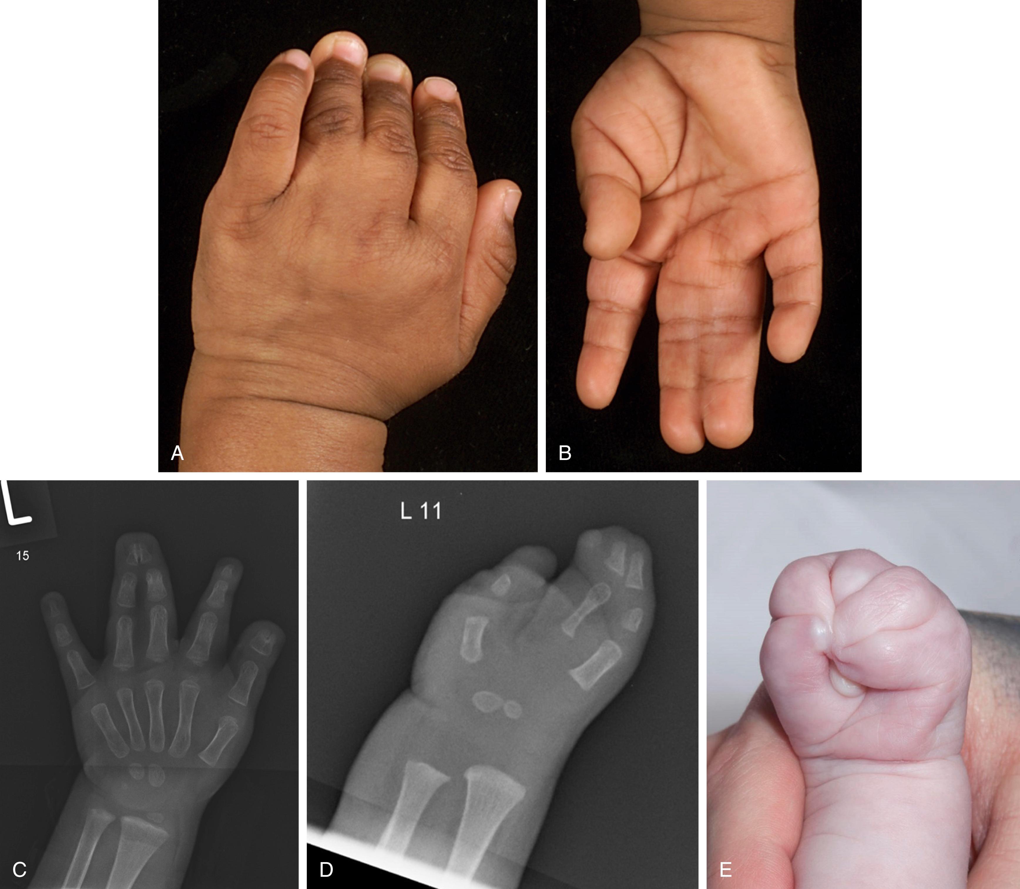 Fig. 45.2, Images of different types of syndactyly. (A) Complete syndactyly. (B) Incomplete syndactyly. (C) Complex syndactyly. (D) Complicated syndactyly. (E) Acrosyndactyly.