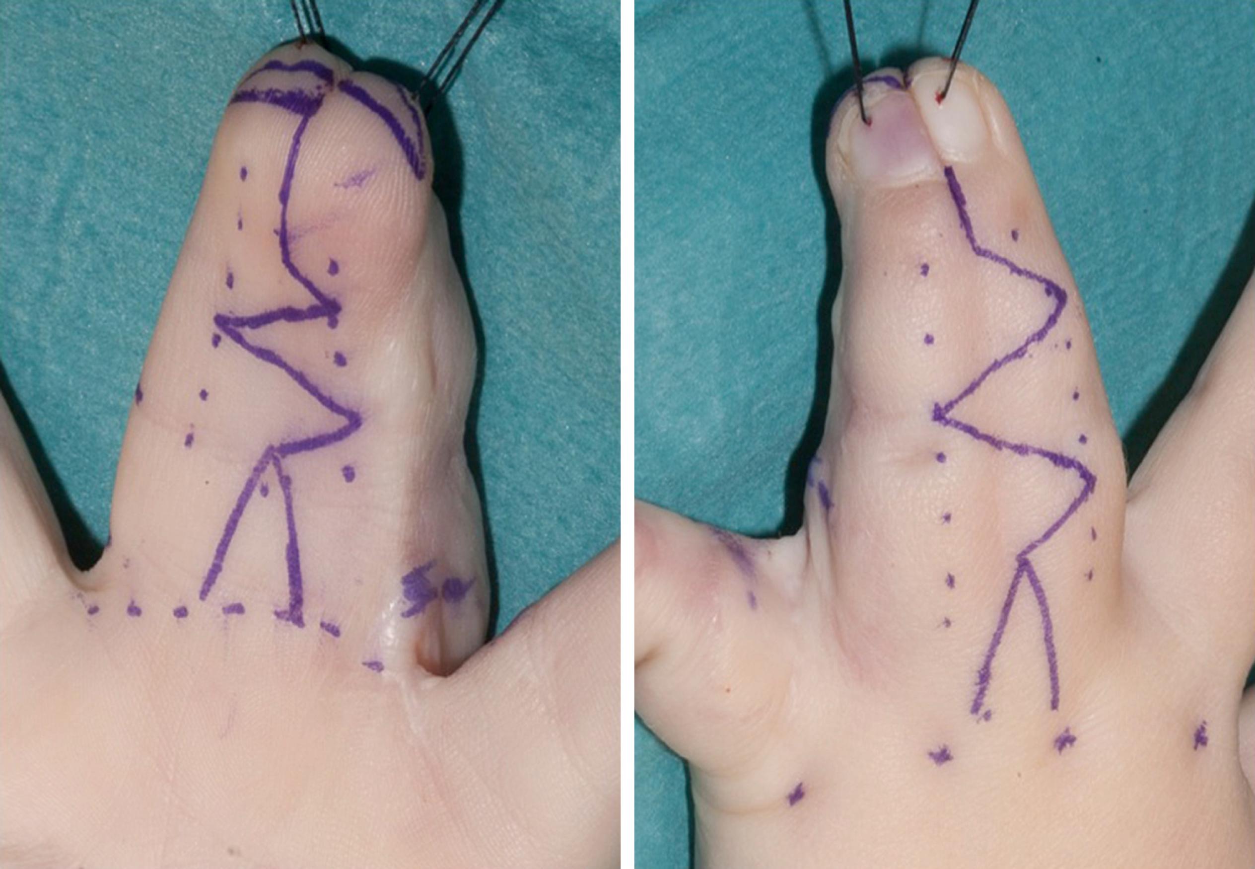 Fig. 45.3, Author’s preferred technique for syndactyly release using interdigitating triangular flaps. Design of interdigitating flaps marked on volar and dorsal sides of simple complete syndactyly.