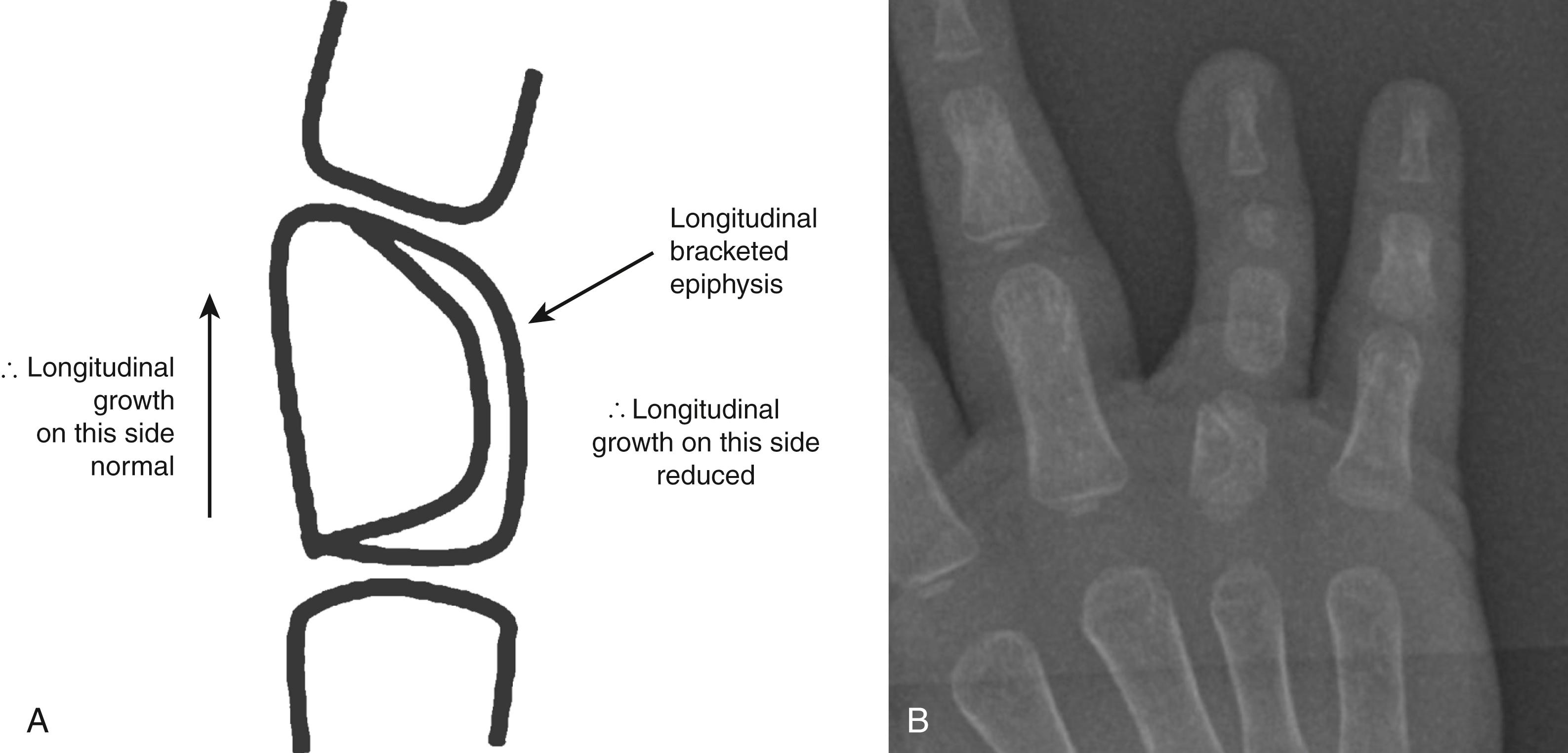 Fig. 45.6, Formation of a trapezoidal phalanx as the result of a longitudinal bracketed epiphysis. (A) Growth on the side of the bracketed epiphysis is compromised. (B) Radiograph of a clinodactylous digit with a trapezoidal proximal phalanx.