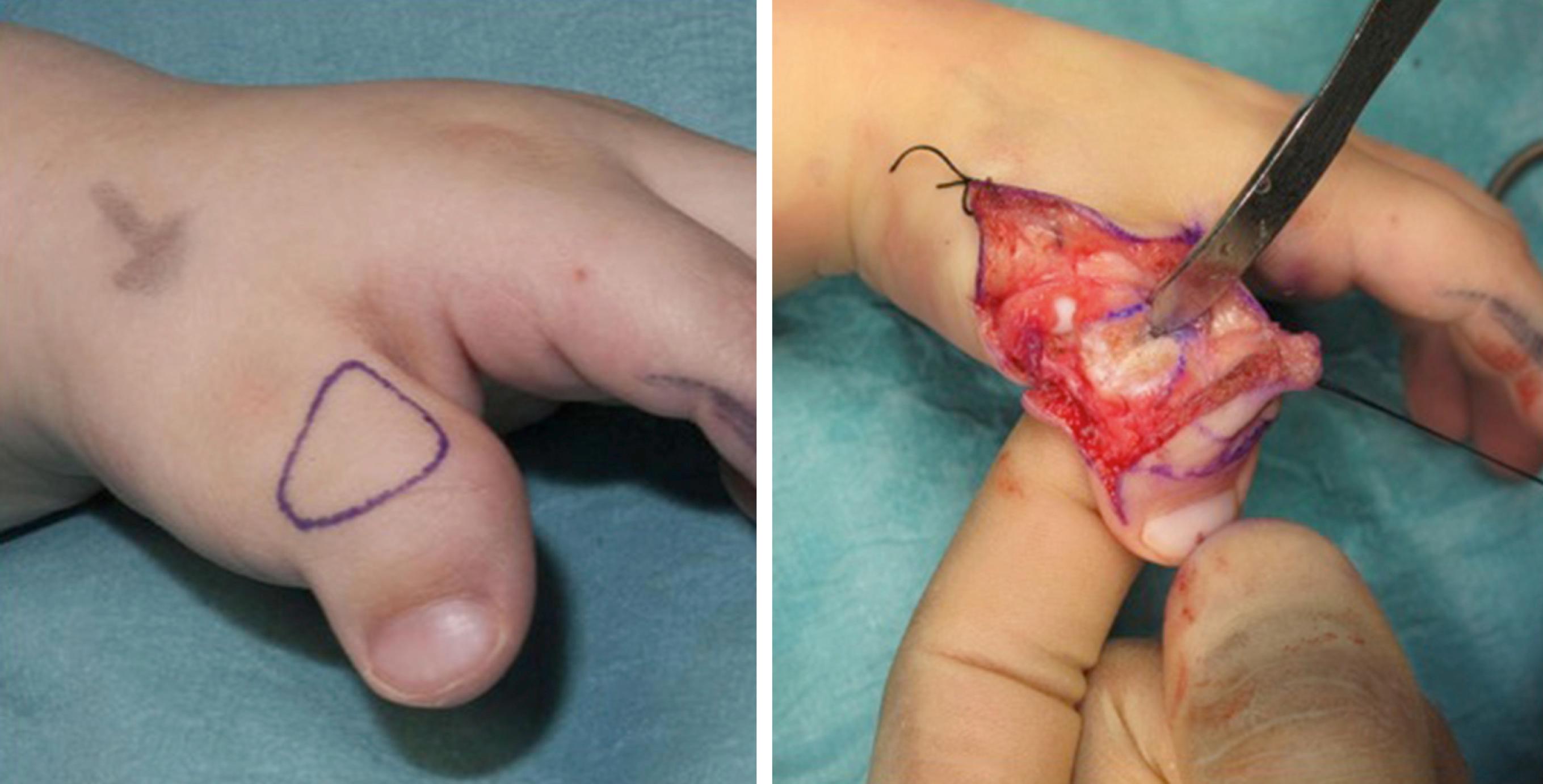 Fig. 45.7, A dome osteotomy for correction of clinodactyly. The dome is created via multiple K-wire holes in an arch configuration linked through the use of an osteotome or fine side-cutting burr.