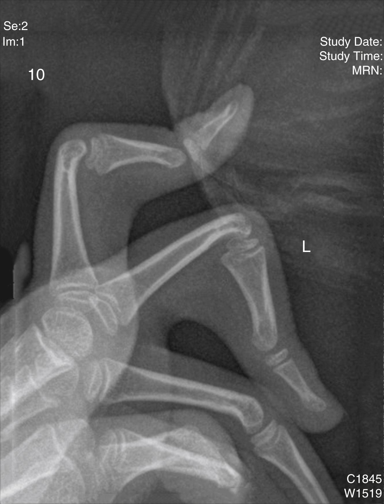 Fig. 45.9, Radiographic image of camptodactylous digits, demonstrating narrowing of the joint space in the proximal interphalangeal joint, flattening with volar curvature of the head of the proximal phalanx, and flattening of the base of the middle phalanx.
