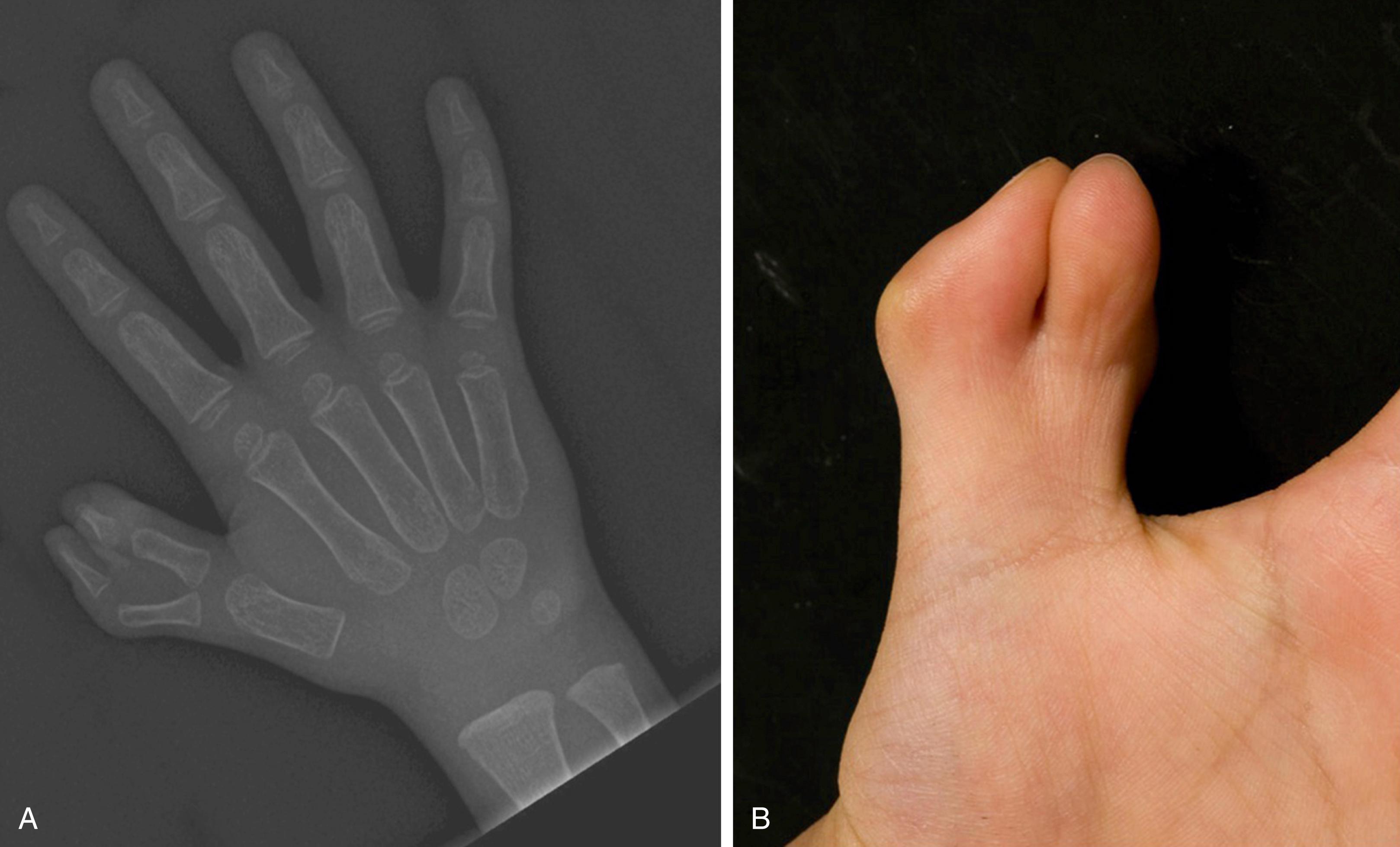 Fig. 45.10, Wassel IV thumb duplication. (A) Radiographic image of a balanced Wassel type IV duplication demonstrating duplication from the proximal phalangeal distally. (B) Image of a patient with a Wassel type IV thumb duplication.