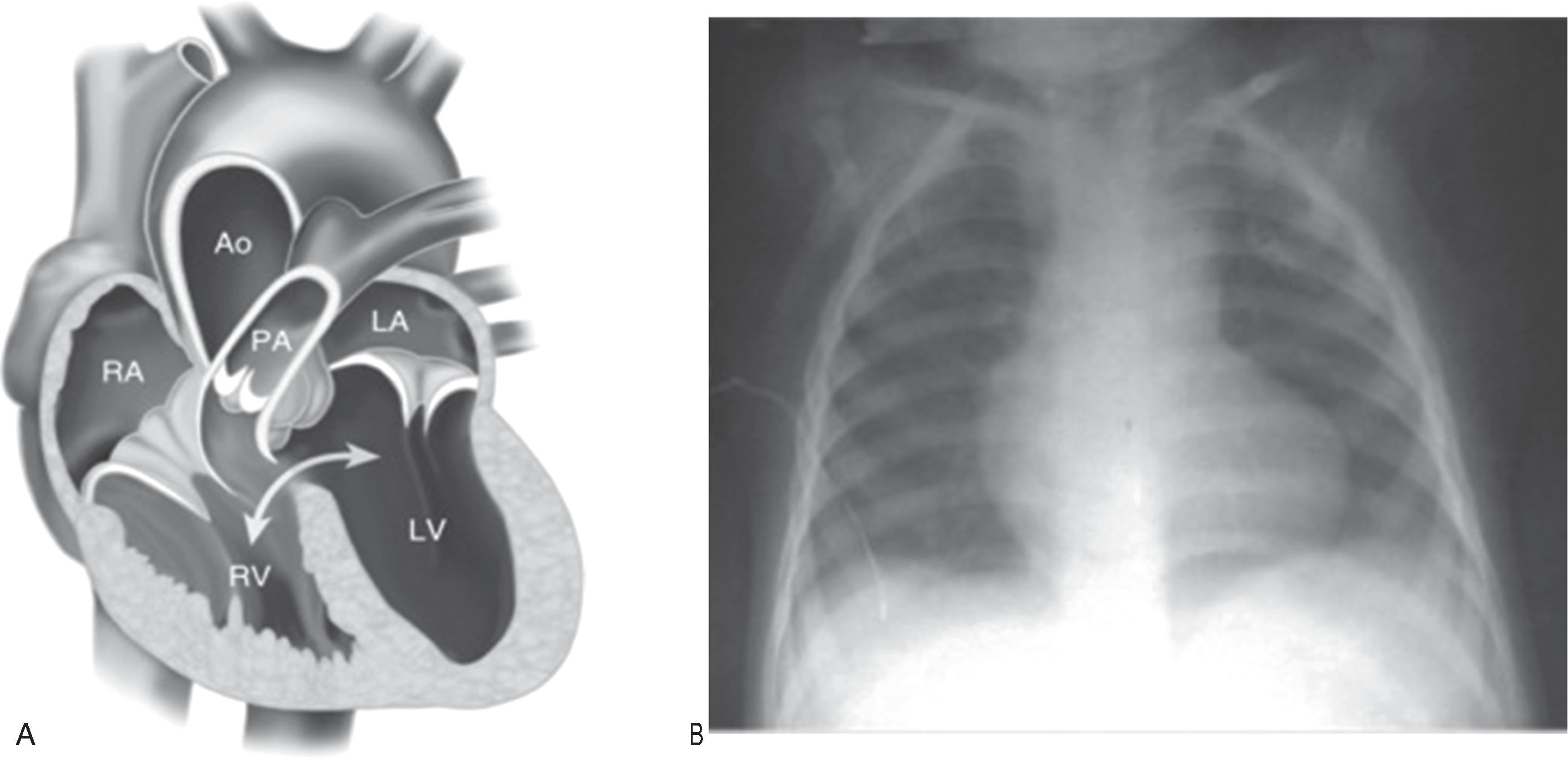 Fig. 36.1, Tetralogy of Fallot (TOF) . (A) Schematic shows a large VSD with an enlarged aorta (Ao) overriding the defect. There is a notable valvular pulmonic stenosis and compensatory right ventricular (RV) hypertrophy. (B) Chest radiograph of a 3-month-old infant with TOF shows a boot-shaped heart. LA, Left atrium; LV, left ventricle; PA, pulmonary artery; RA, right atrium; RV, right ventricle; VSD, ventricular septal defect.