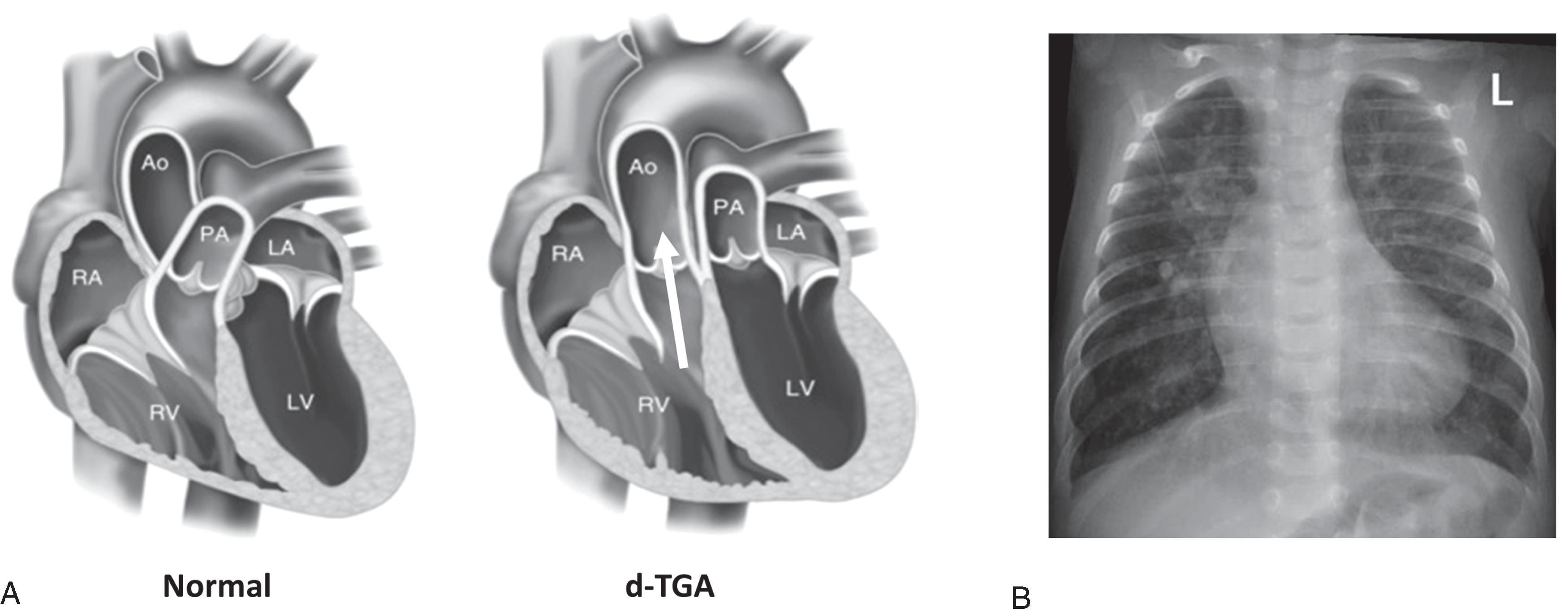 Fig. 36.2, (A) Anatomy of a normal heart and in complete d-transposition of the great arteries (d-TGA). With d-TGA, the aorta arises from the RV (arrow) , and the PA arises from the LV. Before corrective surgery, delivery of oxygenated blood to the systemic circulation depends on intracardiac shunting via an atrial septal defect or a ventricular septal defect. (B) Chest radiograph of an infant with d-TGA showing the egg-on-string appearance. Ao, Aorta; LA, left atrium; LV, left ventricle; PA, pulmonary artery; RA, right atrium; RV, right ventricle. (This figure was modified and reproduced with permission from Otto. Textbook of Clinical Echocardiography , 17, 473–506.)