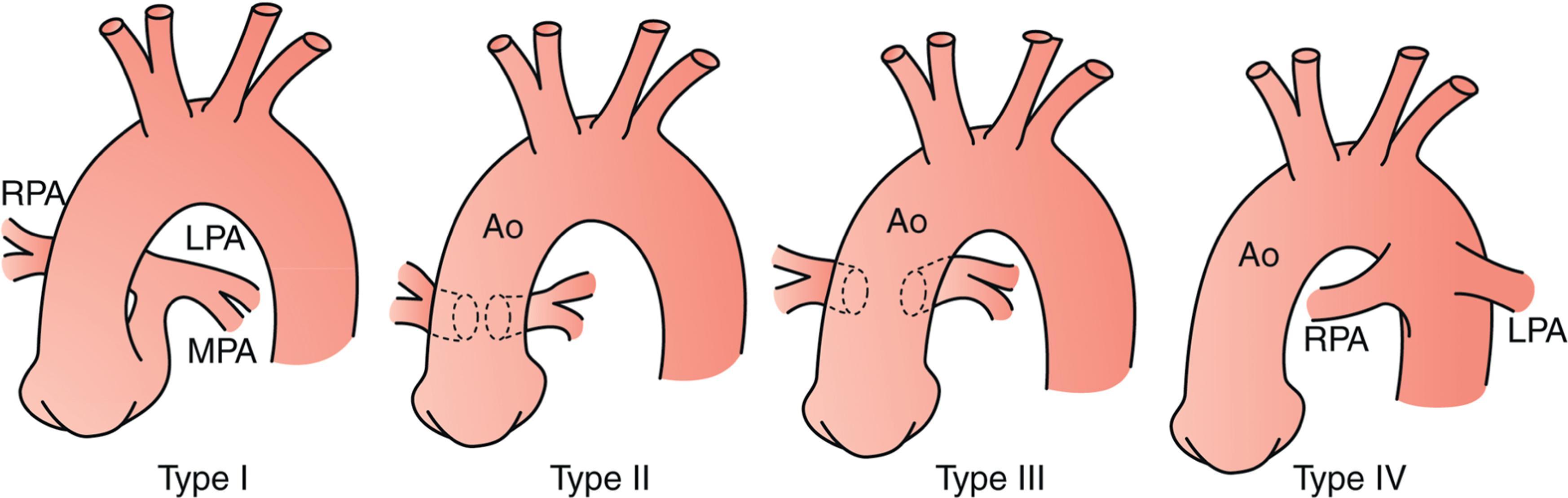 Fig. 36.3, Truncus Arteriosus (Collett-Edwards Classification) . Type I: common main PA with subsequent origins of the branch PAs; Type II: branch PAs arise closely, but separately, from the truncus; Type III: branch pulmonary arteries widely separated in origin on the truncus; Type IV: no pulmonary arterial branch arises from the common trunk. This defect is now recognized as a form of pulmonary atresia with ventricular septal defect. Ao, Aorta; LPA, left pulmonary artery; MPA, main pulmonary artery; RPA, right pulmonary artery. (This figure was modified and reproduced with permission from Well and Fraser. In: Sabiston Textbook of Surgery , chap 59, 1641–1678.)