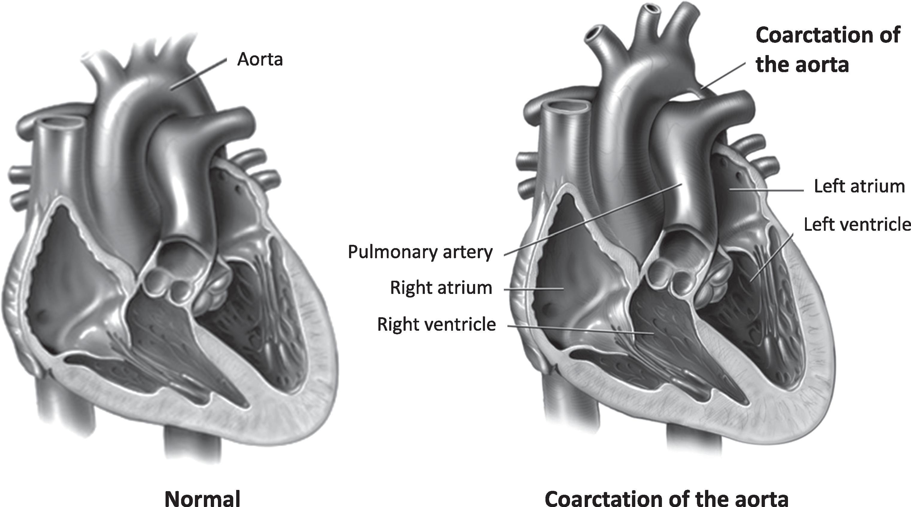 Fig. 36.4, Anatomy of a Normal Heart (Left) and With Coarctation of the Aorta (Right) .