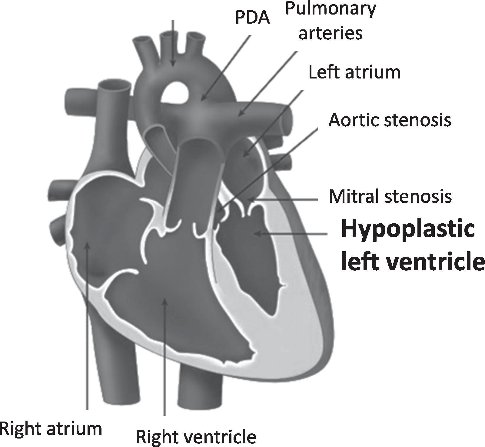 Fig. 36.5, Anatomy of Hypoplastic Left Heart Syndrome.