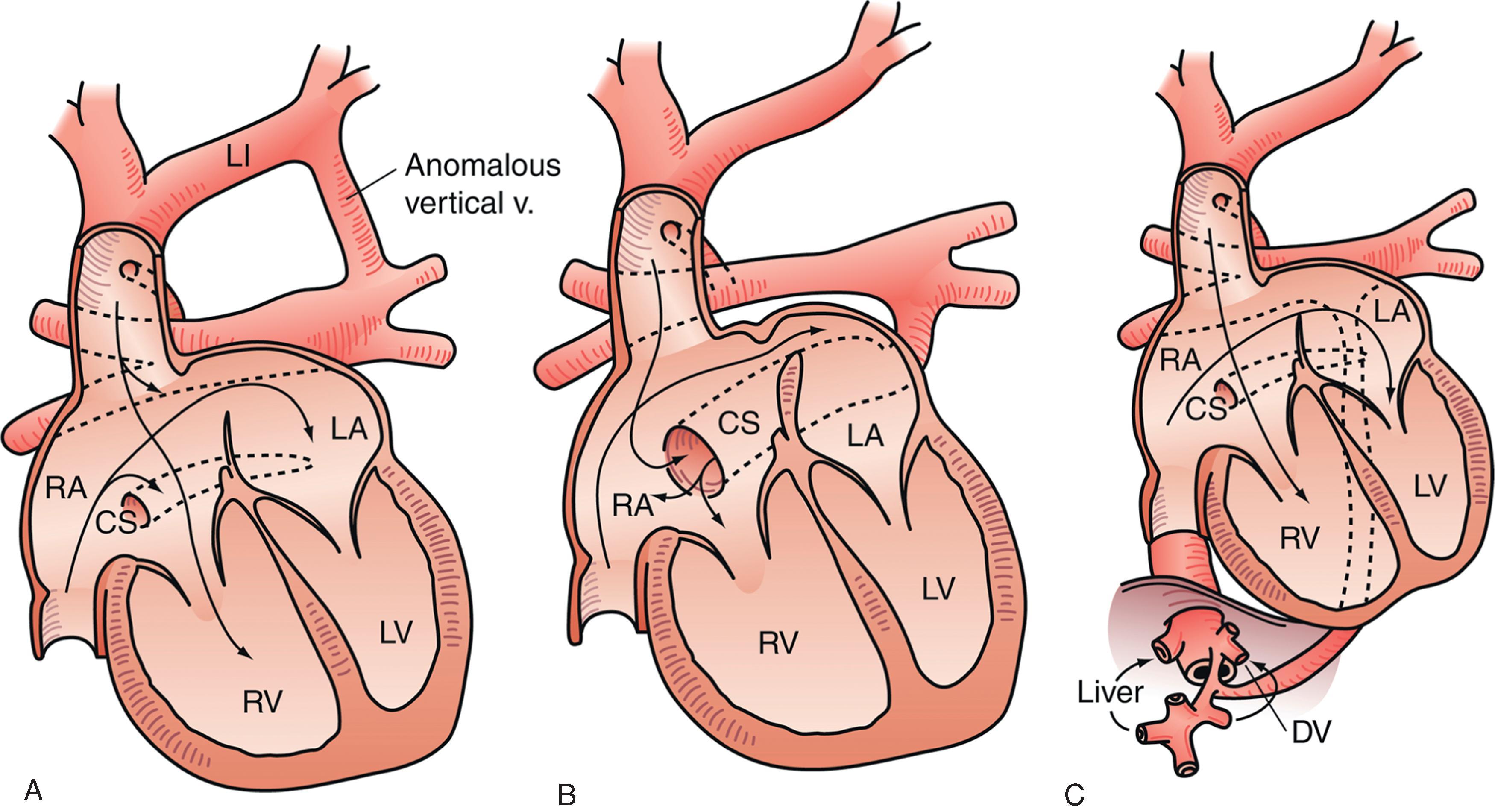 Fig. 36.6, Types of Total Anomalous Pulmonary Venous Connection (TAPVC). (A) Supracardiac type with a vertical vein joining the left innominate (LI) vein. (B) Intracardiac, connected to the coronary sinus (CS). (C) Infracardiac type with drainage through the diaphragm via an inferior connecting vein. DV , Ductus venosus; LA, left atrium; LV, left ventricle; RA, right atrium; RV, right ventricle. (This figure was modified and reproduced with permission from Hammon JW Jr, Bender HW Jr. Anomalous venous connections: pulmonary and systemic.)