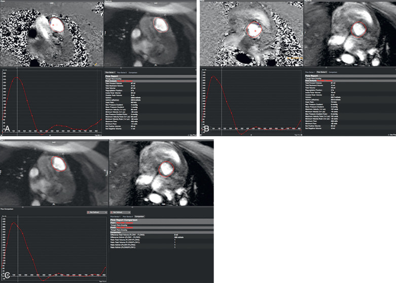 Figure 28.1, Phase and magnitude short-axis images through the pulmonic (A) and aortic (B) valves. After drawing a region of interest (red circle) around the valve for each image throughout the cardiac cycle, you can determine the volume and direction of blood flow, peak velocity, and pressure gradients through the valve to help identify and quantify the amount of valvular disease. (C) Magnitude images through the pulmonic ( right ; flow 1) and aortic ( left ; flow 2) valves used to evaluate for an intracardiac shunt by calculating the ratio of blood flow through the pulmonic valve to the blood flow through the aortic valve (Qp:Qs).