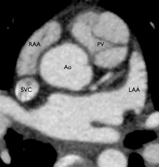 Figure 28.2, Axial oblique image at the level of the atrial appendages from cardiac CT demonstrates the typical broad-based attachment and triangular shape of the right atrial appendage (RAA) and the typical, elongated finger-like shape of the left atrial appendage (LAA). Ao , Aorta; PV , pulmonary valve; SVC , superior vena cava.