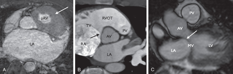 Figure 28.3, (A) Axial image from a contrast-enhanced ECG-gated, respiratory-navigated MR angiography of the chest demonstrates the muscular infundibulum (white arrow) of the right ventricle in this patient with a congenitally corrected L-transposition of the great arteries. (B) Short-axis view of the aortic valve (AV) from cardiac CT demonstrates the muscular separation between the atrioventricular and semilunar valves (black arrow) , which is characteristic of the right ventricle. (C) Steady-state free precession cine image of the pulmonic valve (PV) demonstrates the lack of a muscular separation between the atrioventricular and semilunar valves (white arrow) , characteristic for the left ventricle (LV). LA , Left atrium; MV , mitral valve; pRV, pulmonic right ventricle; RVOT , right ventricular outflow tract; TV , tricuspid valve.