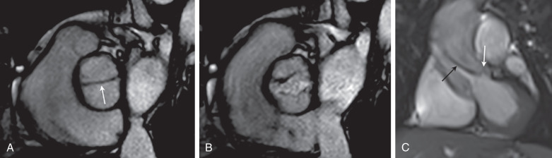 Figure 28.4, Oblique axial steady-state free precession (SSFP) images in both diastole (A) and systole (B) demonstrate a bicuspid morphology of the aortic valve with a fishmouth opening. Note the presence of only a single commissure. (C) Oblique coronal SSFP image during systole demonstrates the typical doming of the aortic valve leaflets (white arrow) with a dephasing jet of associated aortic stenosis (black arrow) .