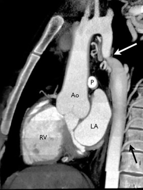 Figure 28.5, Sagittal volume-rendered image from a chest CT scan demonstrates an aortic coarctation (white arrow) occurring within the aortic isthmus. Note how there are multiple thoracic collaterals (black arrow). Ao , Aorta; LA , left atrium; P , pulmonary artery; RV , right ventricle.