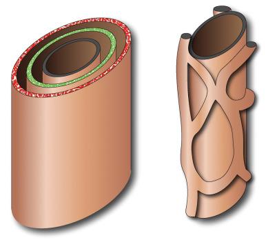 Figure 87.1, Schematic model of ductal plate malformations.