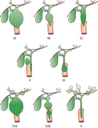 Figure 87.2, Todani classification of choledochal cysts based on cholangiographic morphology.