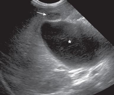 Figure 87.3, Choledochal cyst (Todani type I) in an 8-day-old girl with jaundice.