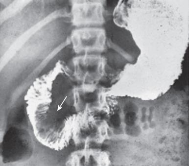 e-Figure 87.4, Choledochocele (Todani type III) in a 12-year-old girl with abdominal pain.