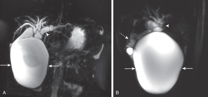 Figure 87.5, Choledochal cyst type I in a 13-year-old girl with abdominal pain.