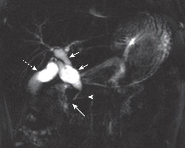 Figure 87.6, Choledochal cyst with common channel in a 7-year-old girl.