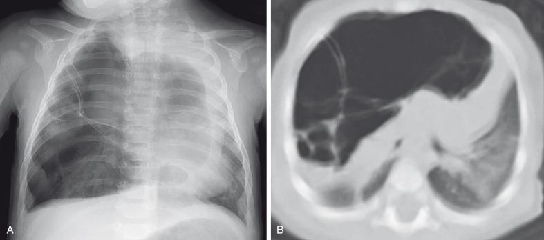 e-Figure 53.11, Cystic pleuropulmonary blastoma in a 6-month-old with increased work of breathing.