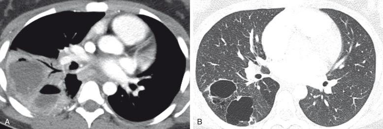 Figure 53.12, Infected CPAM type 1 in a 15-year-old girl.