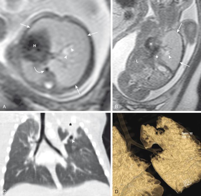 Figure 53.2, Bronchial atresia.